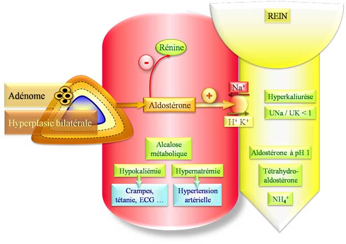 Syndrome de Conn (hyperaldostéronisme primaire)