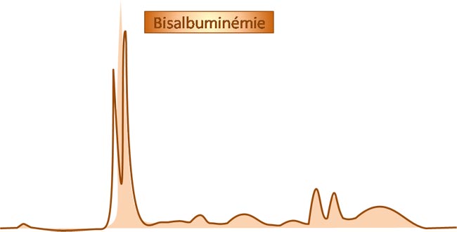 tracé électrophorétique d'une bisalbuminémie