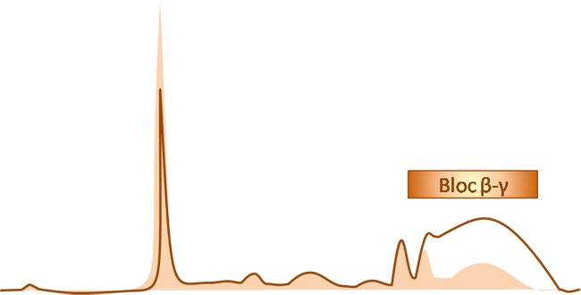 Tracé électrophorétique d'une cirrhose décompensée