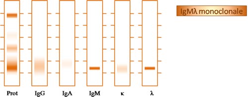 Immunofixation d'une gammapathie monoclonale