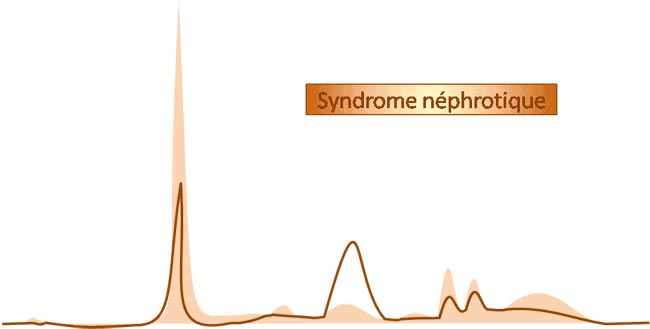 electrophorèse syndrome néphrotique