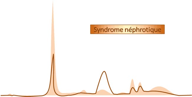 Tracé électrophorétique d'un syndrome néphrotique