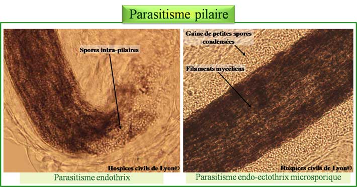 Parasitisme pilaire