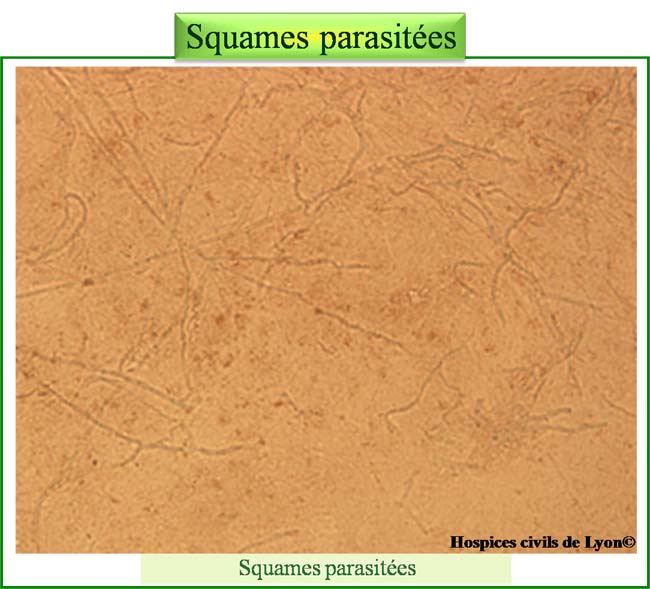 Examen direct de squames et d'ongles