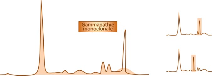 Tracé électrophorétique d'une gammapathie monoclonale