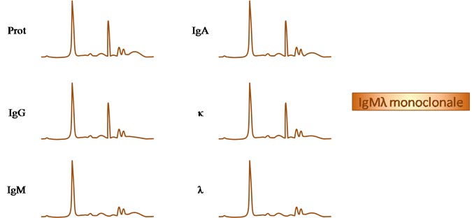 Immunosoustraction d'une gammapathie monoclonale